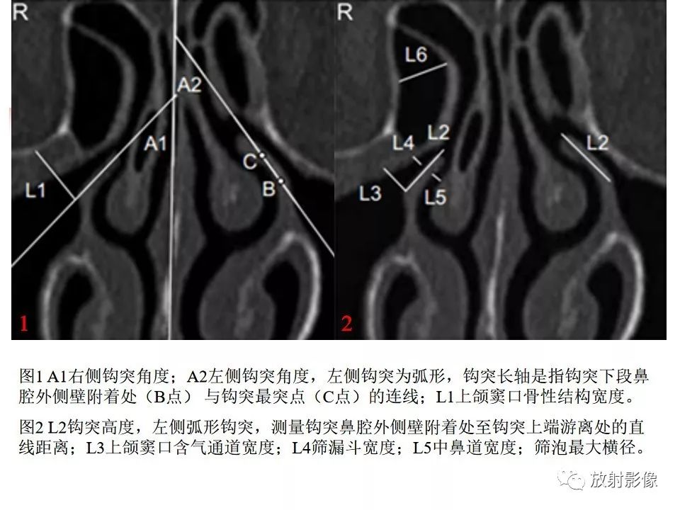 影像PPT - 【PPT】窦口-鼻道复合体影像解剖及临床意义-13
