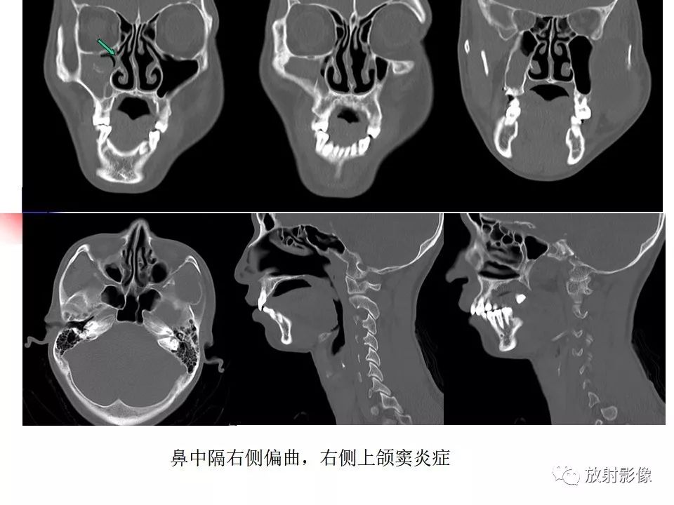 影像PPT - 【PPT】窦口-鼻道复合体影像解剖及临床意义-20