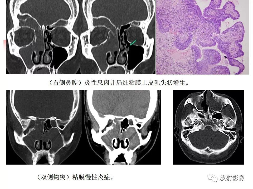 影像PPT - 【PPT】窦口-鼻道复合体影像解剖及临床意义-21