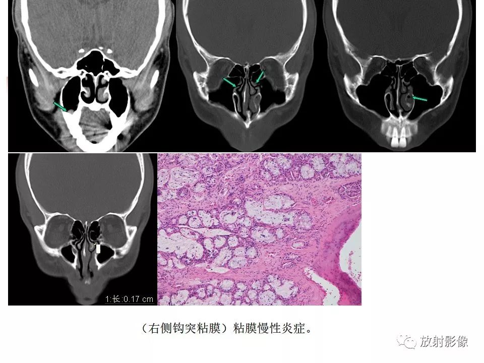 影像PPT - 【PPT】窦口-鼻道复合体影像解剖及临床意义-22
