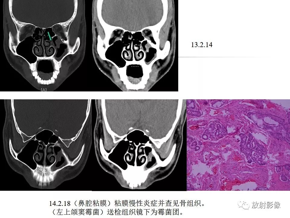 影像PPT - 【PPT】窦口-鼻道复合体影像解剖及临床意义-23