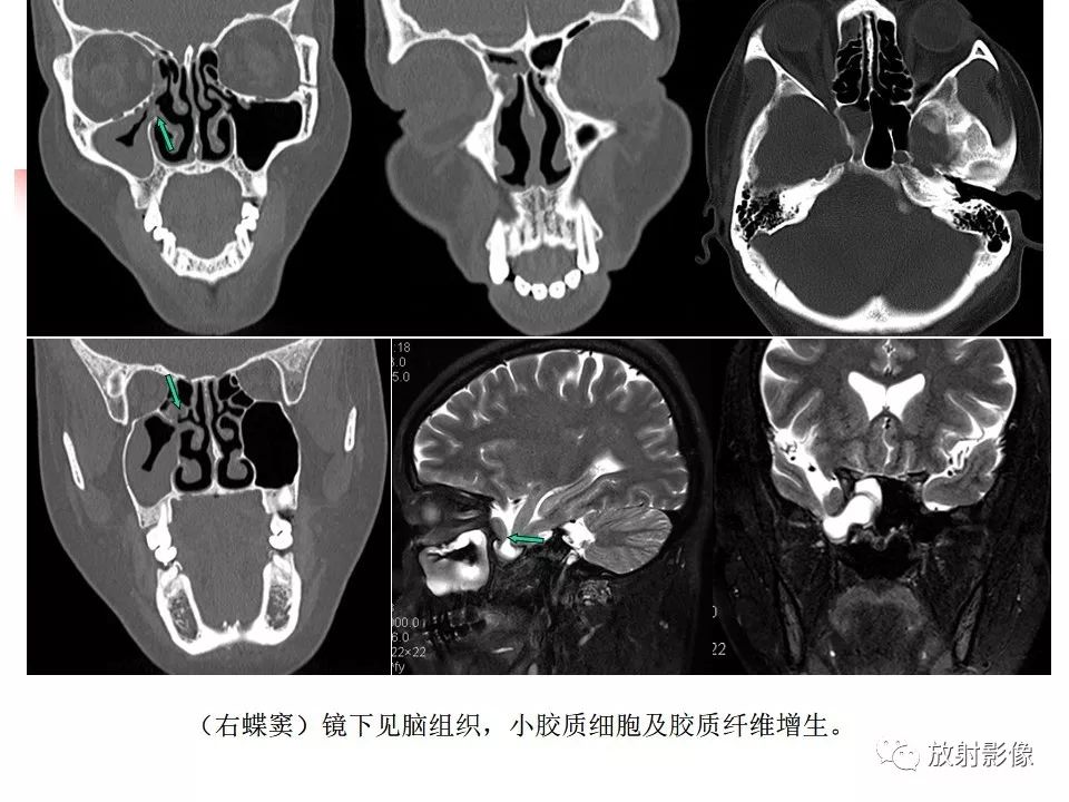 影像PPT - 【PPT】窦口-鼻道复合体影像解剖及临床意义-25