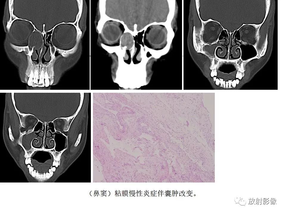 影像PPT - 【PPT】窦口-鼻道复合体影像解剖及临床意义-26