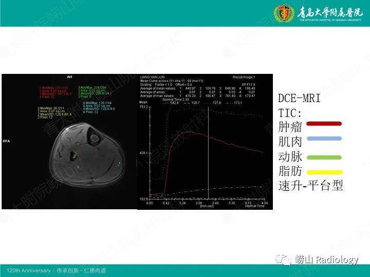 影像PPT - 【PPT】小腿滑膜肉瘤1例CT及MR影像-5