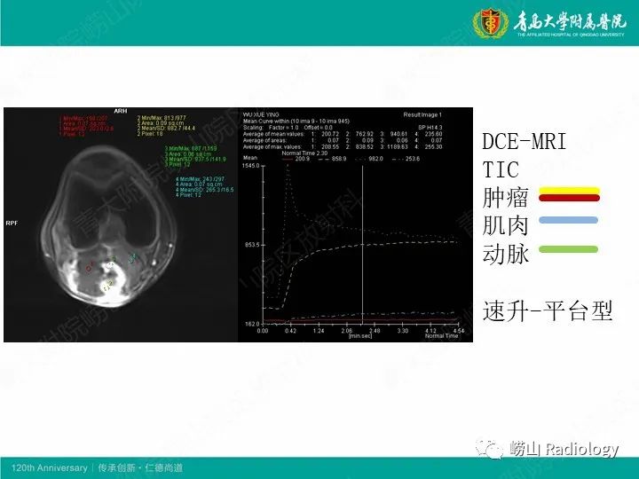 影像PPT - 【PPT】小腿滑膜肉瘤1例CT及MR影像-19