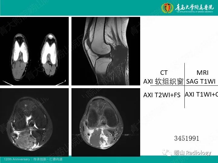 影像PPT - 【PPT】小腿滑膜肉瘤1例CT及MR影像-18