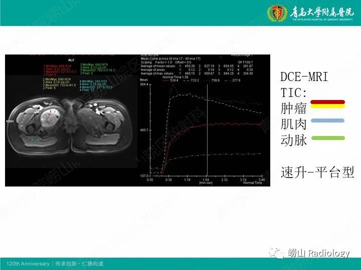影像PPT - 【PPT】小腿滑膜肉瘤1例CT及MR影像-22