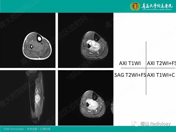 影像PPT - 【PPT】小腿滑膜肉瘤1例CT及MR影像-4