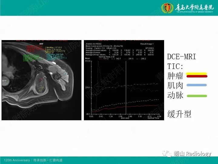 影像PPT - 【PPT】小腿滑膜肉瘤1例CT及MR影像-25