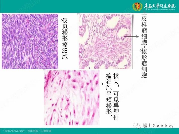 影像PPT - 【PPT】小腿滑膜肉瘤1例CT及MR影像-10