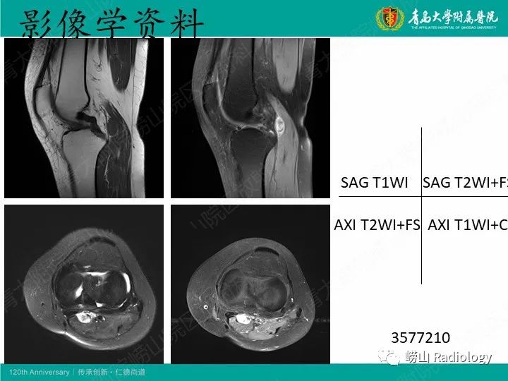 影像PPT - 【PPT】小腿滑膜肉瘤1例CT及MR影像-14
