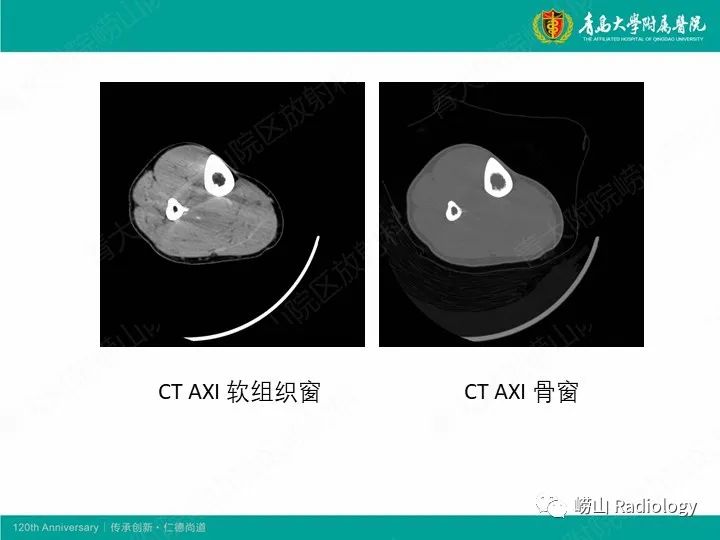 影像PPT - 【PPT】小腿滑膜肉瘤1例CT及MR影像-3