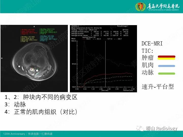 影像PPT - 【PPT】小腿滑膜肉瘤1例CT及MR影像-15
