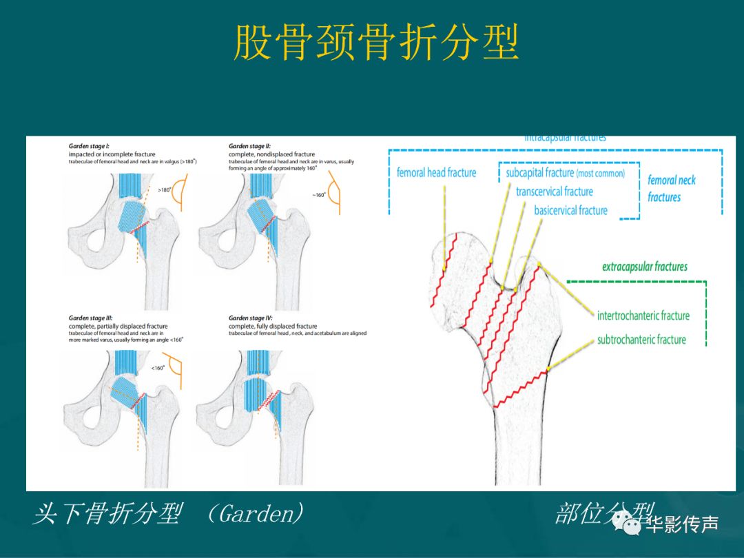 影像PPT - 【PPT】髋关节创伤的影像诊断-8 影像PPT - 【PPT】髋关节创伤的影像诊断-8