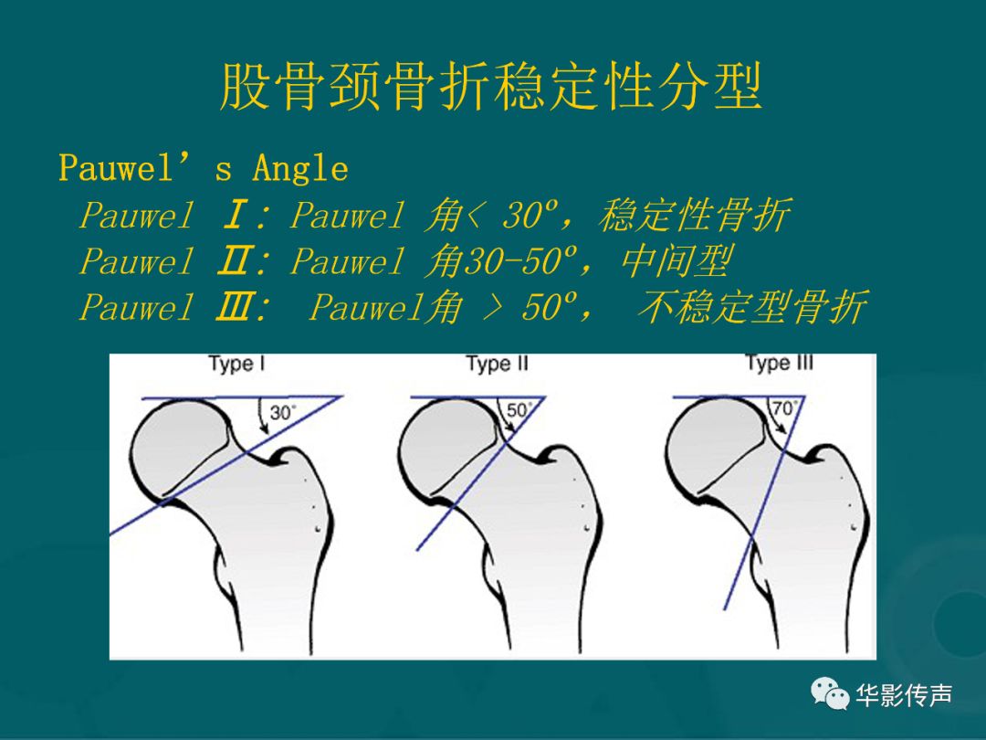 影像PPT - 【PPT】髋关节创伤的影像诊断-9 影像PPT - 【PPT】髋关节创伤的影像诊断-9