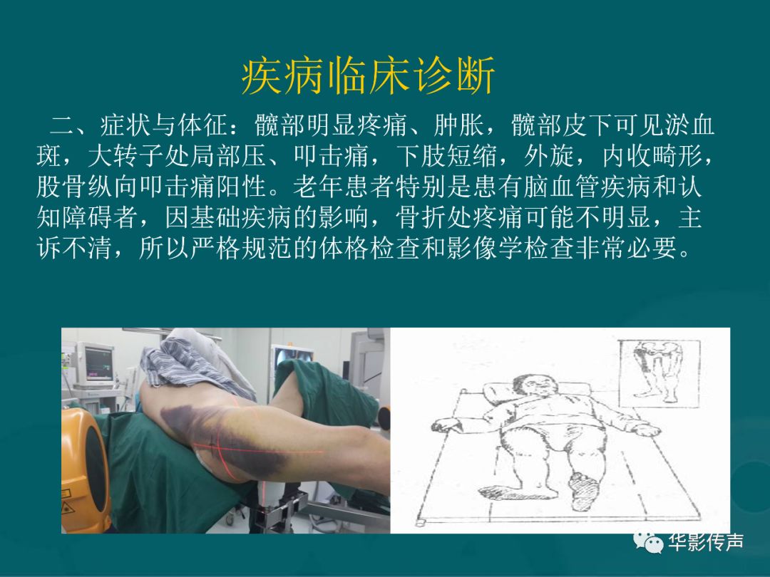 影像PPT - 【PPT】髋关节创伤的影像诊断-6 影像PPT - 【PPT】髋关节创伤的影像诊断-6
