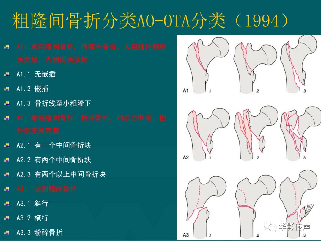 影像PPT - 【PPT】髋关节创伤的影像诊断-11 影像PPT - 【PPT】髋关节创伤的影像诊断-11