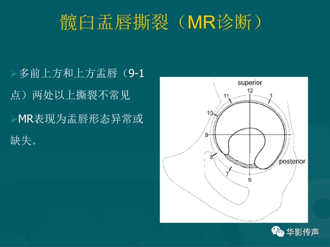 影像PPT - 【PPT】髋关节创伤的影像诊断-24 影像PPT - 【PPT】髋关节创伤的影像诊断-24