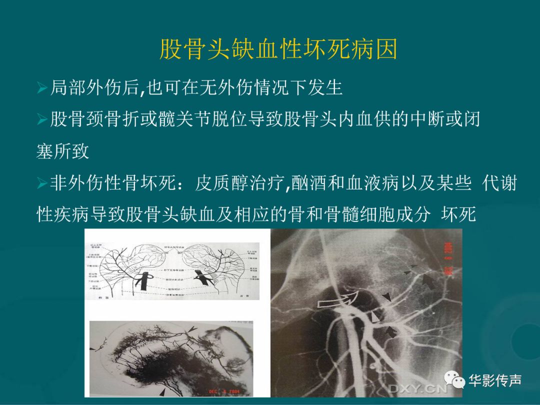 影像PPT - 【PPT】髋关节创伤的影像诊断-34 影像PPT - 【PPT】髋关节创伤的影像诊断-34
