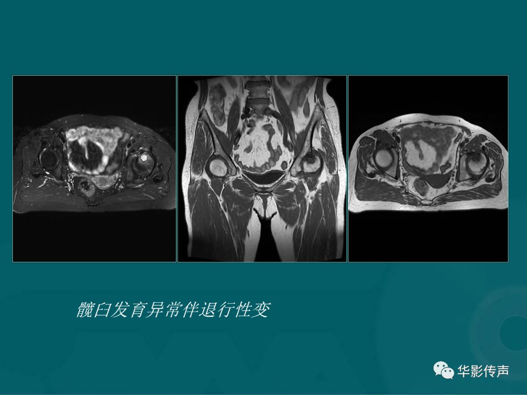 影像PPT - 【PPT】髋关节创伤的影像诊断-57 影像PPT - 【PPT】髋关节创伤的影像诊断-57