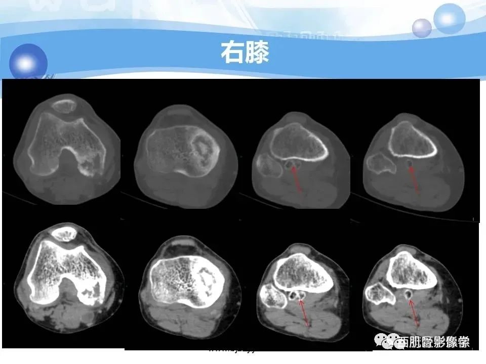 影像PPT - 【PPT】滑膜软骨瘤病与游离体-3