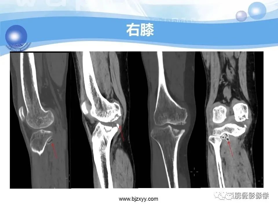 影像PPT - 【PPT】滑膜软骨瘤病与游离体-4