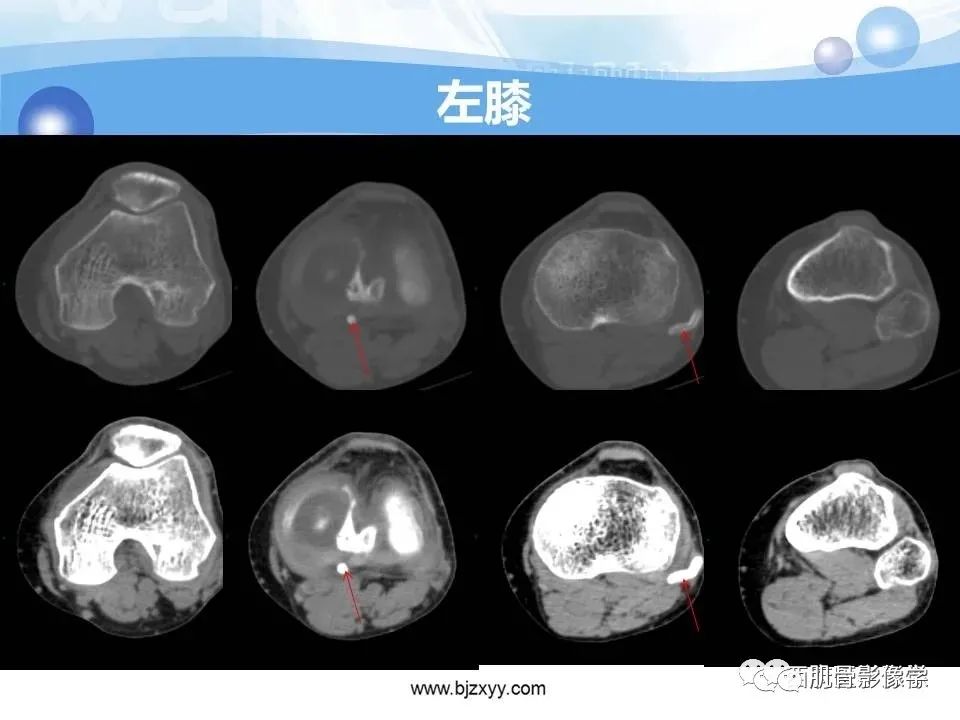 影像PPT - 【PPT】滑膜软骨瘤病与游离体-5