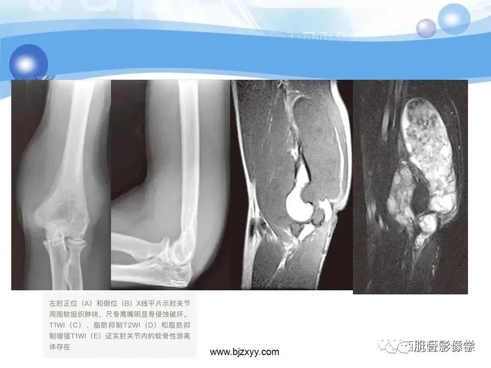 影像PPT - 【PPT】滑膜软骨瘤病与游离体-16