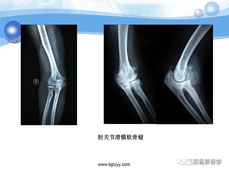 影像PPT - 【PPT】滑膜软骨瘤病与游离体-15
