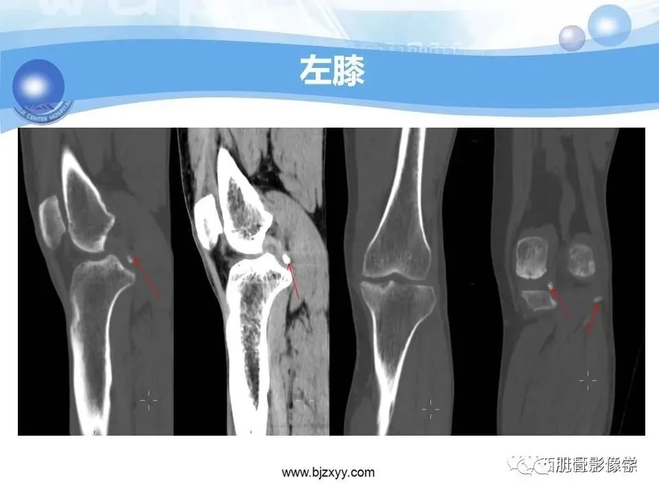 影像PPT - 【PPT】滑膜软骨瘤病与游离体-6