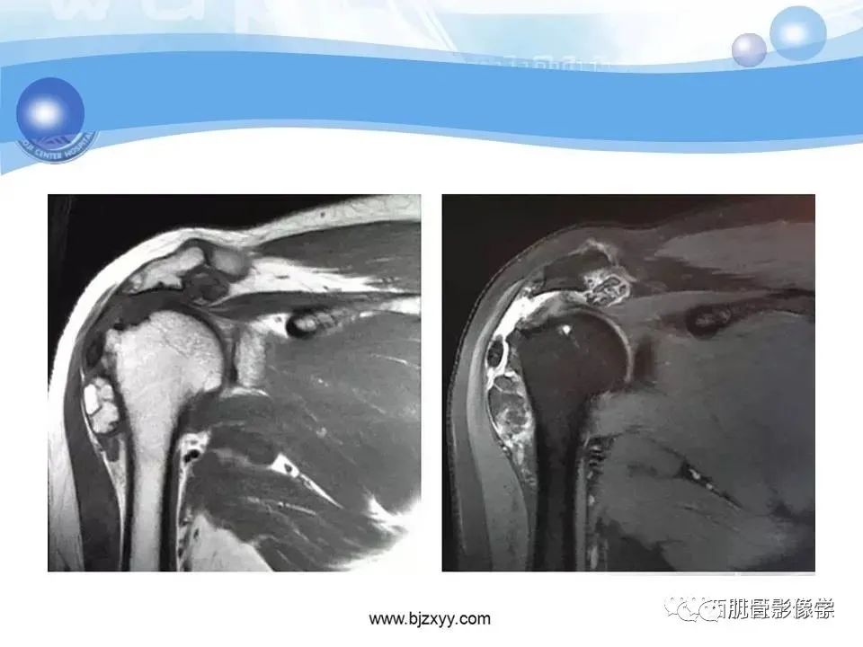 影像PPT - 【PPT】滑膜软骨瘤病与游离体-18
