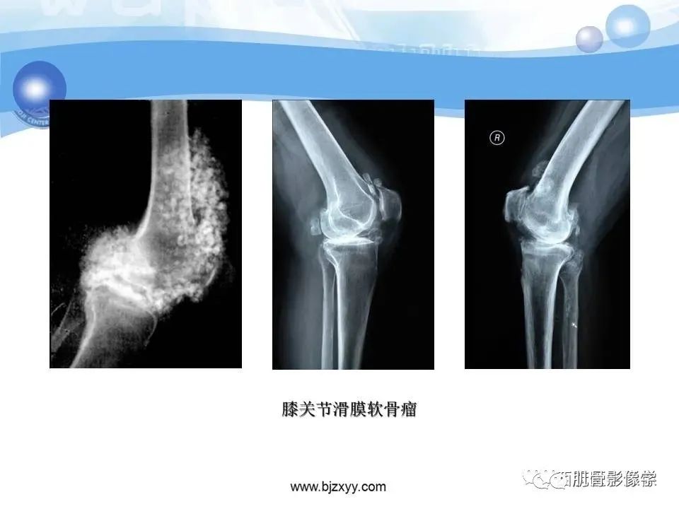 影像PPT - 【PPT】滑膜软骨瘤病与游离体-14