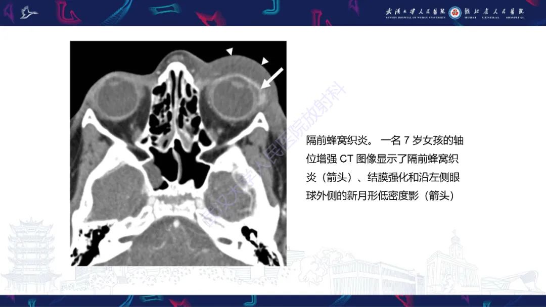 影像PPT - 【PPT】儿童眼眶感染性及炎性病变影像诊断-16