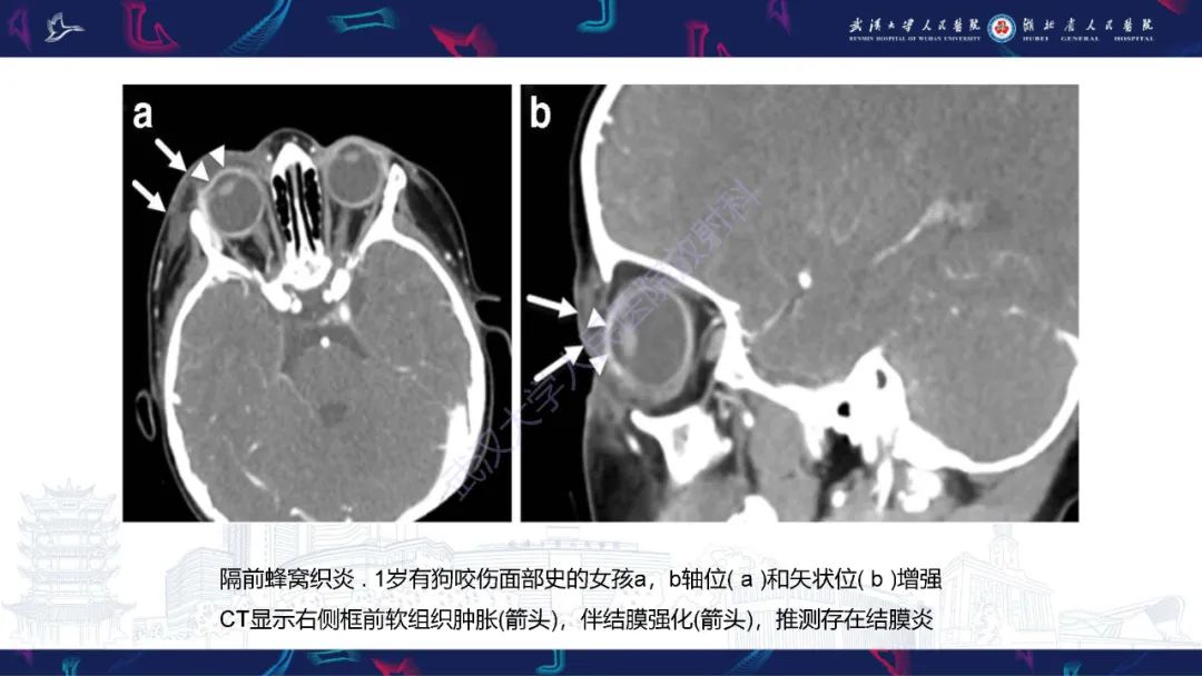 影像PPT - 【PPT】儿童眼眶感染性及炎性病变影像诊断-15