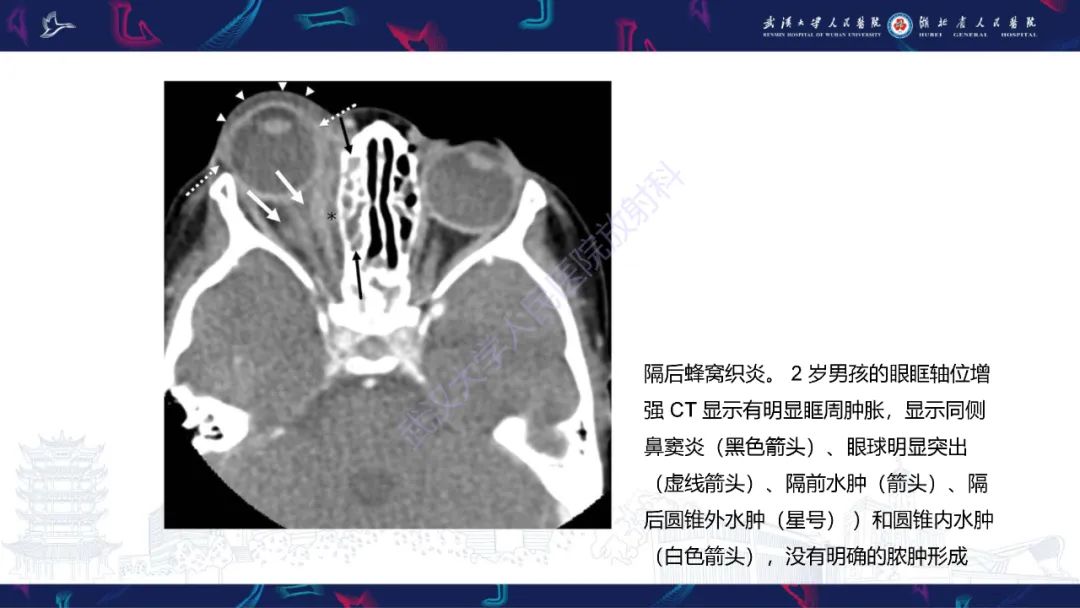 影像PPT - 【PPT】儿童眼眶感染性及炎性病变影像诊断-18