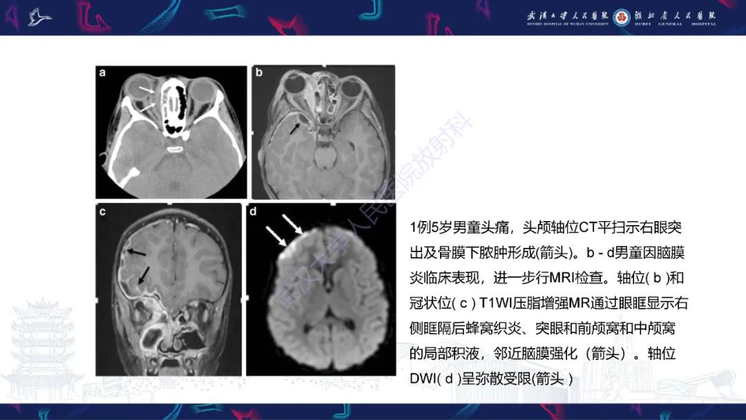 影像PPT - 【PPT】儿童眼眶感染性及炎性病变影像诊断-10