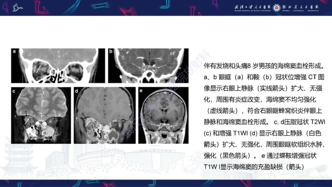 影像PPT - 【PPT】儿童眼眶感染性及炎性病变影像诊断-24