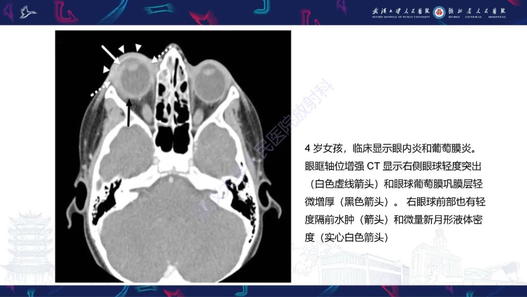 影像PPT - 【PPT】儿童眼眶感染性及炎性病变影像诊断-30