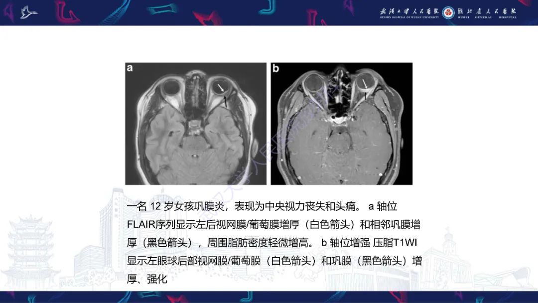 影像PPT - 【PPT】儿童眼眶感染性及炎性病变影像诊断-27