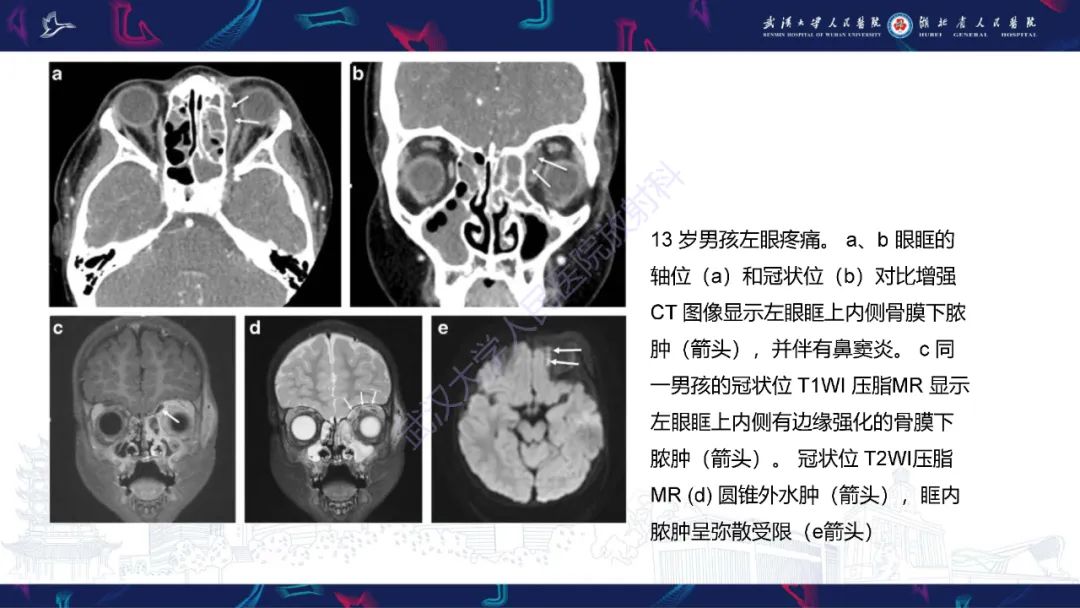 影像PPT - 【PPT】儿童眼眶感染性及炎性病变影像诊断-21