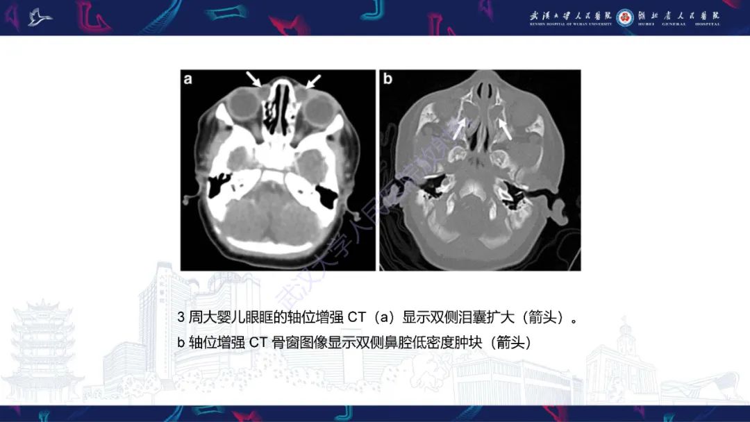 影像PPT - 【PPT】儿童眼眶感染性及炎性病变影像诊断-35
