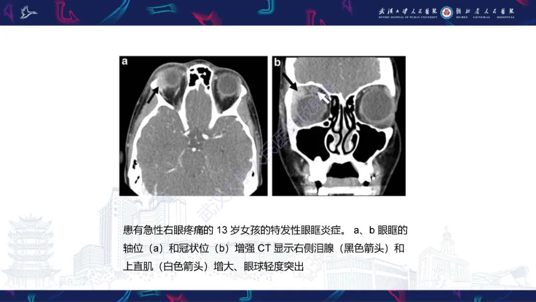 影像PPT - 【PPT】儿童眼眶感染性及炎性病变影像诊断-38