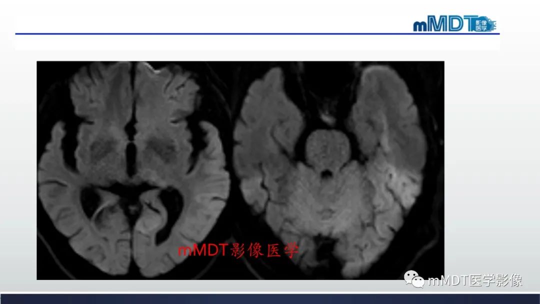 影像PPT - 【PPT】神经梅毒病例分析及图文综述-7