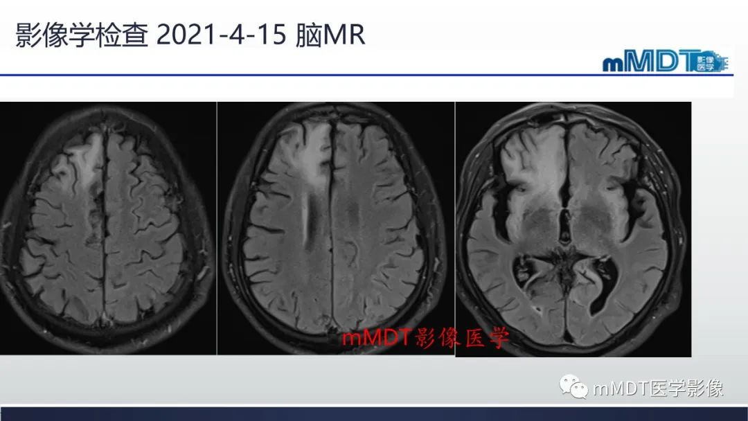 影像PPT - 【PPT】神经梅毒病例分析及图文综述-4