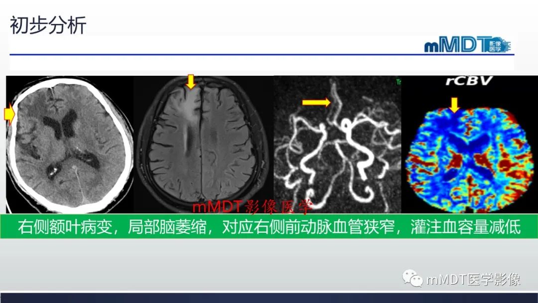 影像PPT - 【PPT】神经梅毒病例分析及图文综述-10