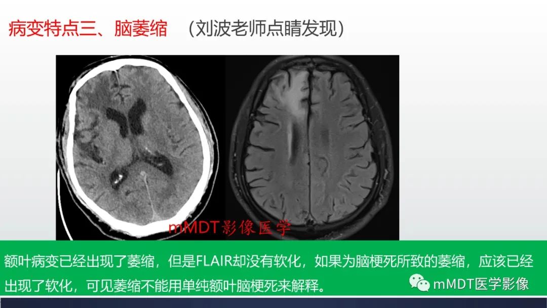 影像PPT - 【PPT】神经梅毒病例分析及图文综述-19