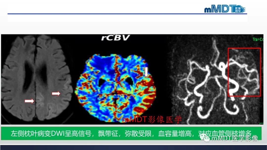 影像PPT - 【PPT】神经梅毒病例分析及图文综述-11