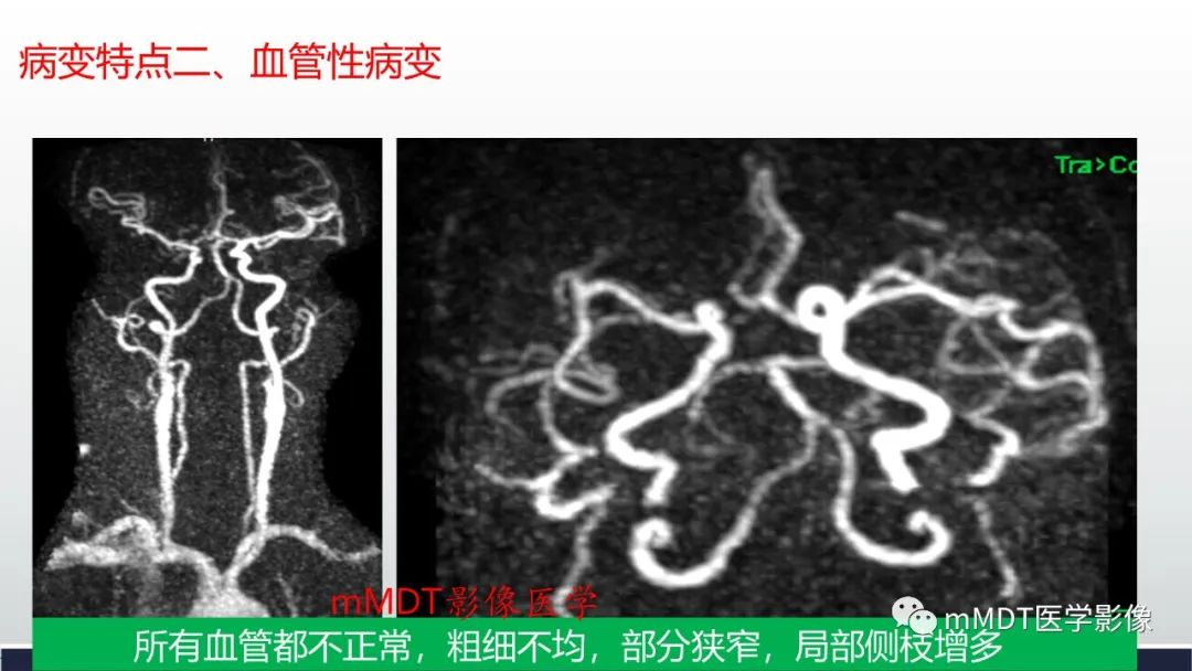 影像PPT - 【PPT】神经梅毒病例分析及图文综述-13
