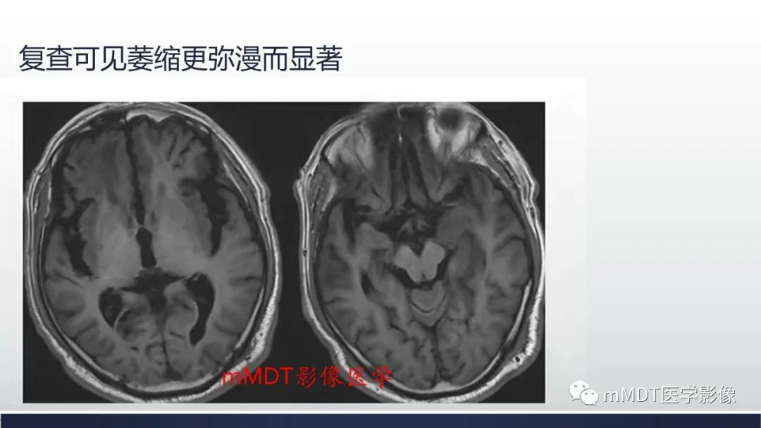 影像PPT - 【PPT】神经梅毒病例分析及图文综述-29