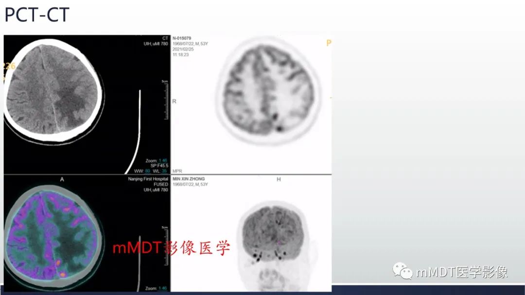 影像PPT - 【PPT】神经梅毒病例分析及图文综述-38